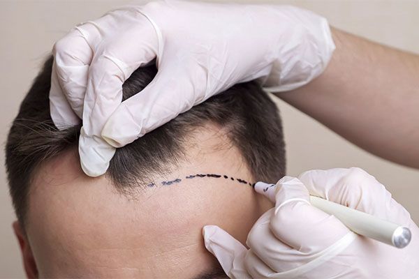 Cuir chevelu d'un homme souffrant d'alopécie et en attente d'un diagnostic ou d'une greffe capillaire. Les avantages greffe de cheveux : le guide complet pour retrouver votre densité