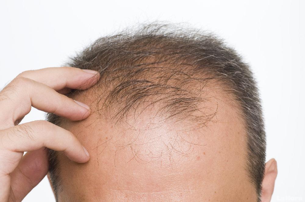 Alopécie: causes et traitements