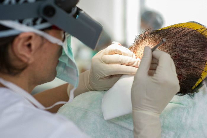 Médecin effectuant une greffe de cheveux.