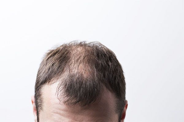 La perte de cheveux pendant la chimiothérapie est un fait. Elle se manifeste de manière égale chez les hommes et les femmes, en conséquence de la puissance des médicaments utilisés au cours de ce traitement qui attaquent les cellules cancéreuses à croissance rapide, affectant également d’autres cellules à croissance rapide telles que celles responsables de la croissance des cheveux.