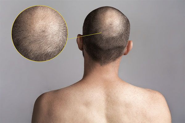 Si vos cheveux n'arrêtent pas de tomber et que vous ne savez pas quoi faire pour arrêter la chute, la première chose à savoir est que, quel que soit votre problème, il a une solution.