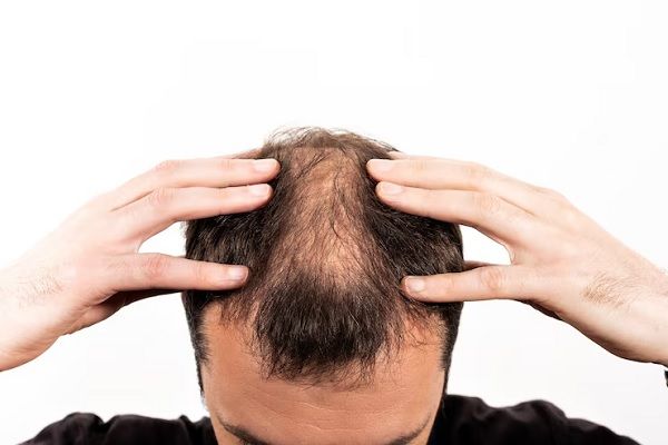 Homme montrant son cuir chevelu, traitements de l'alopécie areata
