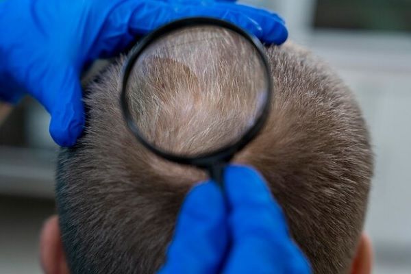 Spécialiste examinant le cuir chevelu d'un patient à l'aide d'une loupe. 