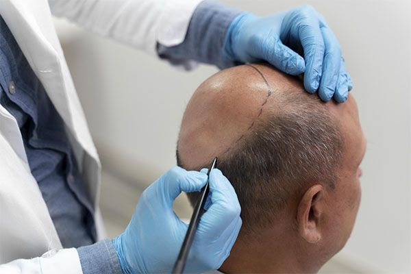 La greffe de cheveux FUE: la meilleure option contre la calvitie