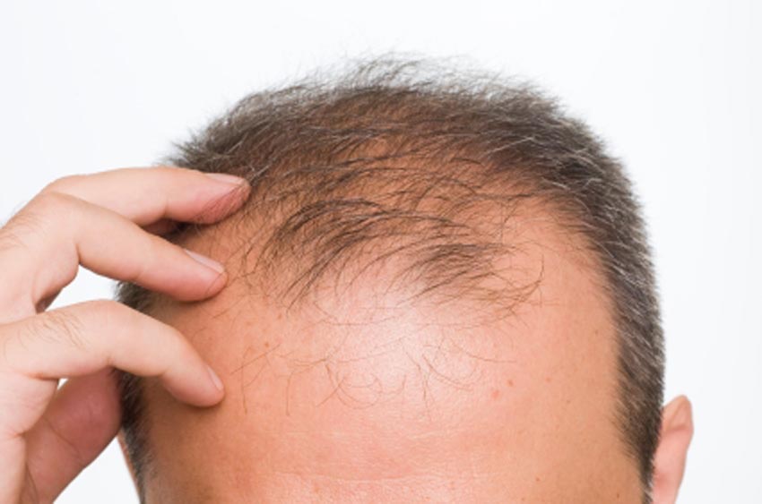 Photo Greffe de Cheveux : Le Guide Complet 2026
