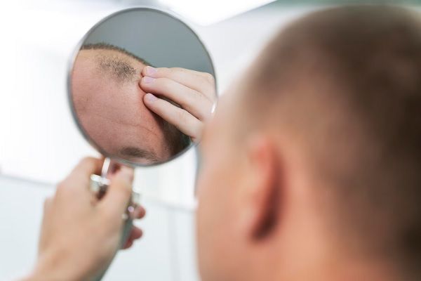 adulte ayant des problèmes de calvitie, Comment récupérer les cheveux perdus ?
