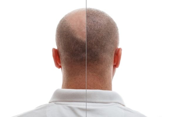 Homme souffrant d'alopécie, vous pouvez voir les progrès réalisés après une greffe de cheveux.
