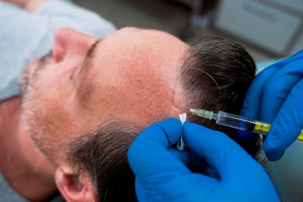 homme recevant une anesthésie pour une greffe de cheveux.