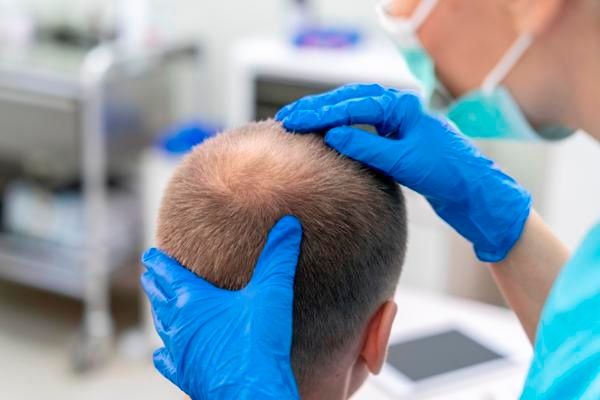 homme traité pour alopécie. Comment se déroule une greffe de cheveux ?