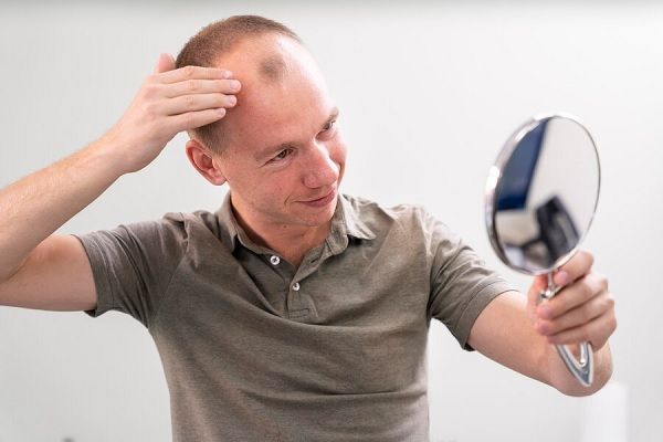 Homme adulte ayant des problèmes de calvitie, Comment éviter la chute des cheveux