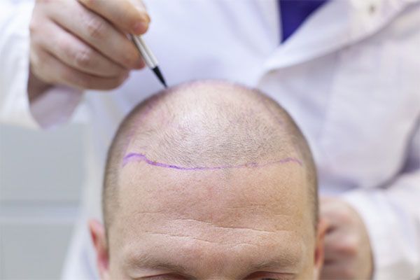 Si la greffe de cheveux s'est bien passée, ce qui est le cas de toutes les greffes effectuées dans les cliniques les plus expérimentées. greffe de cheveux en France