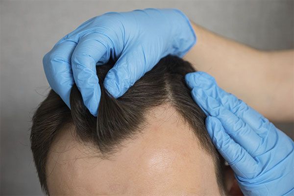 . Le changement de couleur coïncidera avec la chute des croûtes dans la zone donneuse. greffe de cheveux
