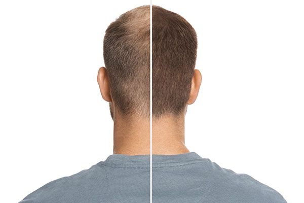 Greffe de cheveux: questions