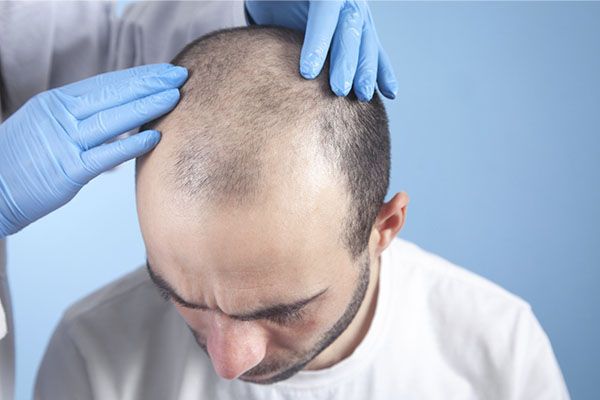 Les quantités étant souvent mal comprises hors contexte. resultat greffe de cheveux