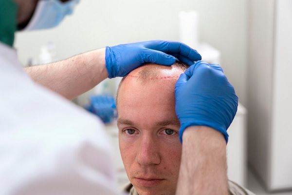 Homme adulte recevant un traitement contre la perte de cheveux.