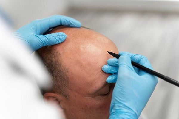 Homme adulte recevant un traitement contre la perte de cheveux.
