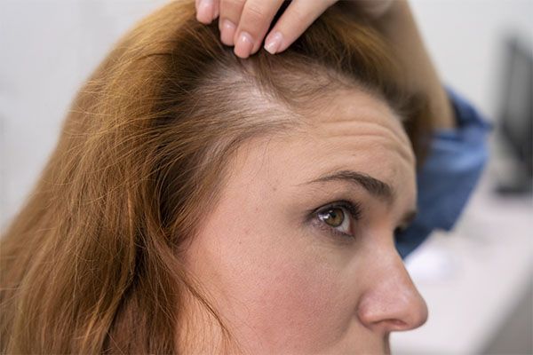 Femme recevant un traitement contre la perte de cheveux dans une clinique