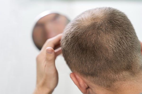 Pour de nombreuses personnes, dont des célébrités françaises , la calvitie fait partie de leur quotidien. personnalités françaises greffe de cheveux