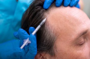 Adult male getting a hair loss treatment