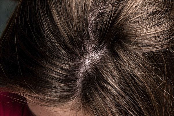 Cuir chevelu d'une femme aux cheveux bruns. . hémangiome capillaire