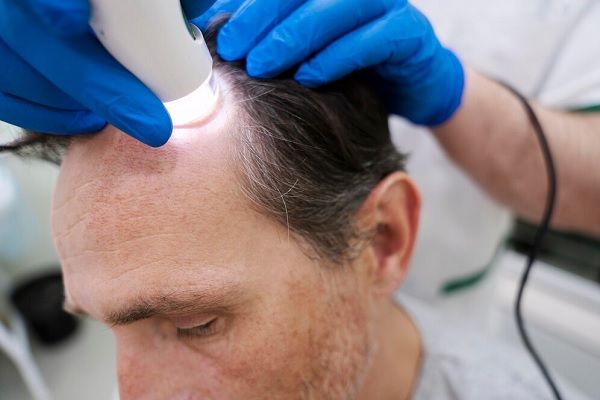 Homme recevant un traitement contre la perte de cheveux.