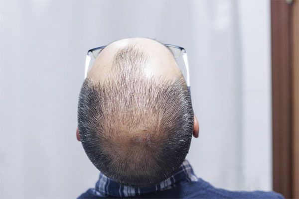 Homme souffrant d'alopécie et portant des lunettes, regardant vers le haut.