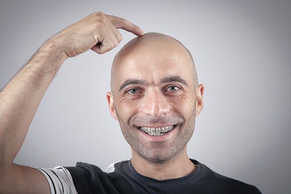 Homme atteint d'alopécie souriant, la main sur la tête.