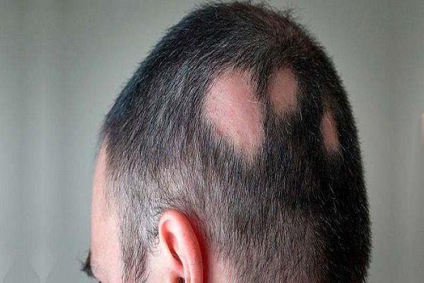 Homme sur le côté avec des taches sur la tête dues à la pelade