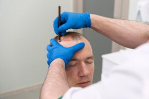Homme mûr avec des problèmes de calvitie