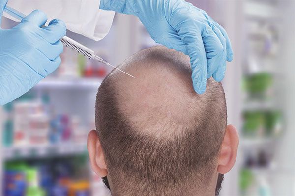 Le coût d'une greffe de cheveux par la technique MicroFUE peut varier considérablement en fonction de plusieurs facteurs.