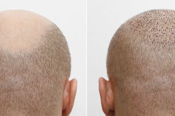 Si vous décidez de subir une greffe de cheveux, n'attendez pas plus longtemps pour nous contacter. Technique MicroFUE