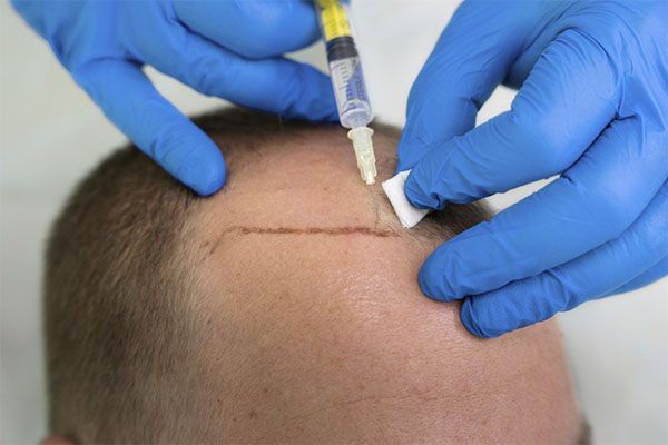Un médecin effectue un traitement capillaire sur un homme en vue d'une greffe de cheveux. meilleur clinique greffe de cheveux France.