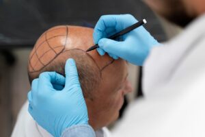 Homme subissant un processus d'extraction d'unités folliculaires. greffe de cheveux en France