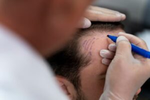 Un homme en cours de greffe de cheveux chez un bon spécialiste.