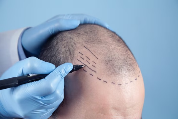 Homme audacieux subissant un processus d'extraction d'unités folliculaires.