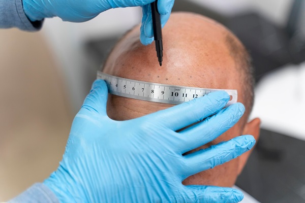 Un homme subissant une greffe capillaire dans une clinique prestigieuse.