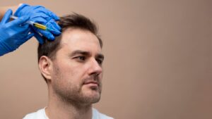 Un homme reçoit une injection de PRP pour une alopécie. prix des greffes de cheveux