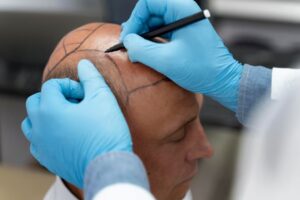 technologie utilisée influence-t-elle la greffe de cheveux
