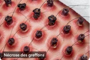 Nécrose des greffons