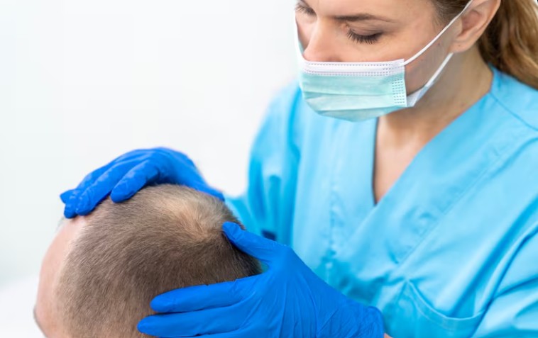 Photo Greffe de cheveux : nombre de UF par zone à couvrir